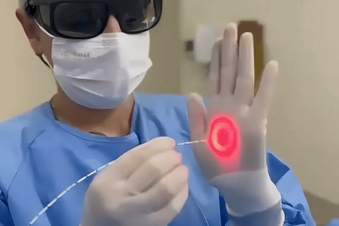Tratamento a laser para cisto pilonidal